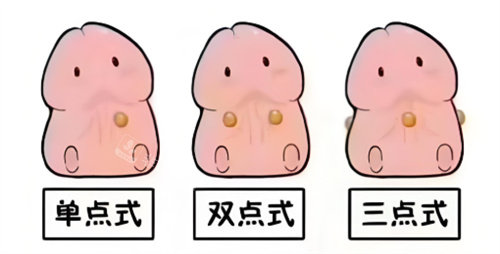 入珠手术动画