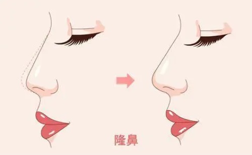 韩国无植入物隆鼻术是什么?自体软骨还是玻尿酸?了解整形外科新技术就看这一篇!