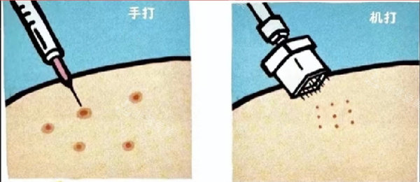 水光注射注射