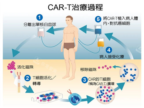 CART细胞疗法治疗过程