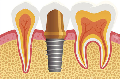 种植牙和临牙图片