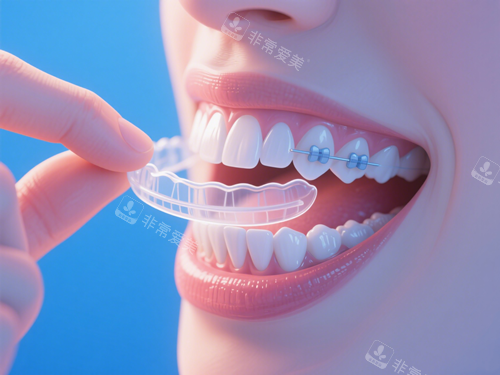 隐形牙套和附件