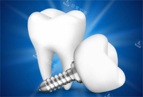 2颗种植牙模型图