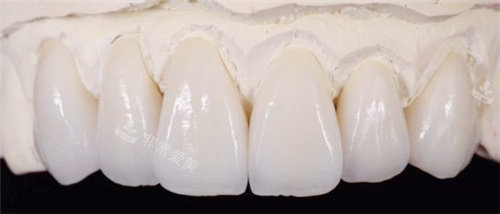 vita全瓷牙展示