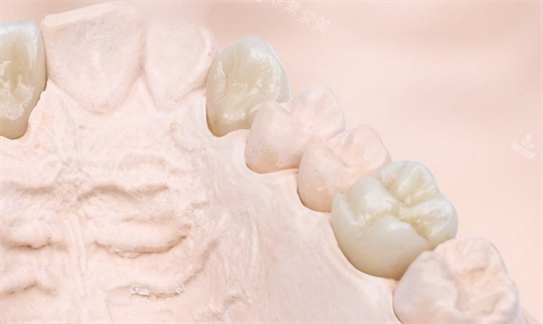 则武全瓷牙模型展示