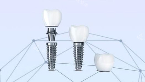 口腔种植牙改善