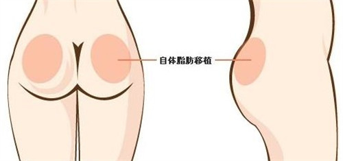 韩国假体丰臀超给力！前后对比惊现理想臀型，亲身体验感舒适又安心