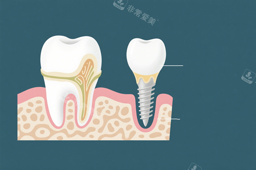 种植牙示意图 (1)