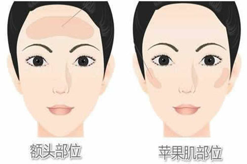 王世虎医生做面部脂肪填充怎么样，技术娴熟有多年的脂肪填充手术经验！