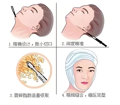 网选萍乡面部吸脂手术医院排名：希美整形|星悦医疗美容|丽芙医疗美容面吸口碑好！