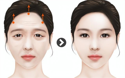 宜春提眉手术哪里好？名星医疗美容和韩美整形做提眉手术技术好口碑好！