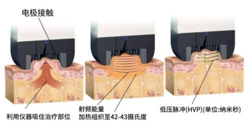 韩国身体做inmode大腿两侧需要49万韩币，我个人觉得是很值得选择的项目！