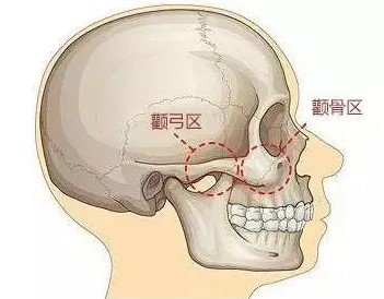 我去韩国做面部轮廓失败修复手术经历:颧骨修复1300万韩币、下颌角截骨850万韩币、长曲线截骨800万韩币