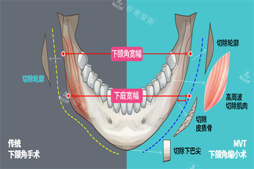 下颌角手术宣传图