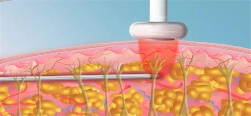 我在韩国皮肤科做了ONDA20KJ溶脂套餐：手臂+腹部+大腿三个部位价格179万韩币，成效很满意！