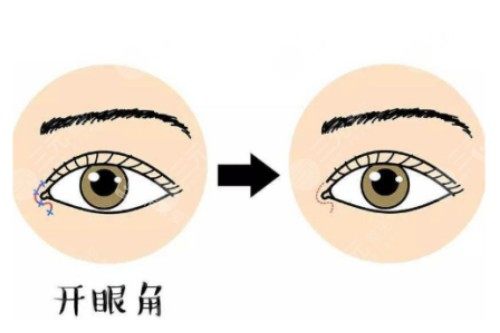 开眼角对比图