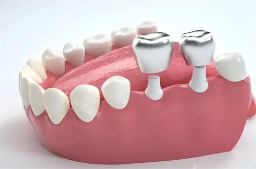 种植牙示意图片