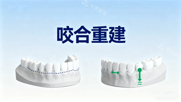 咬合重建