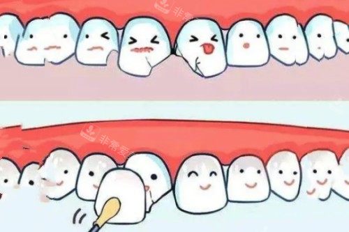 牙贴面卡通图