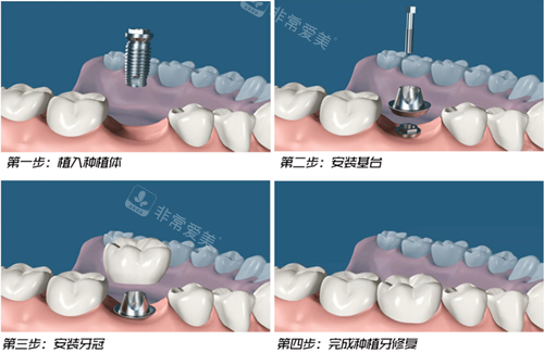 种植牙过程图示