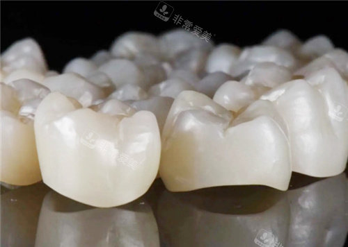 威兰德全瓷牙图示