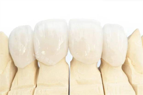 全瓷牙冠佩戴模型展示