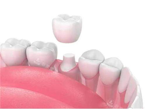 牙齿戴牙冠示意图