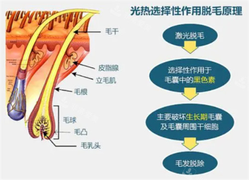光子脱毛的原理