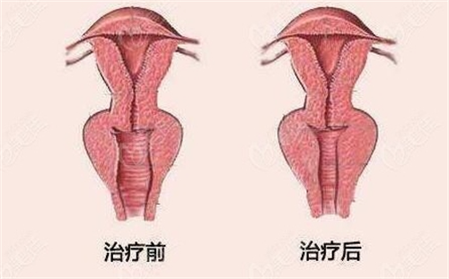 亲身实测！韩国私密整形怎么样？体验感超舒适，前后对比惊艳到我