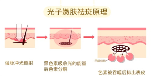 35岁女性适合做的整形项目:光子嫩肤+超声炮黄金+热玛吉抗初老组合人气高！