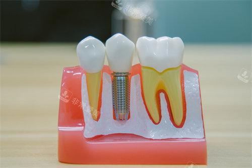 牙科种植牙模型