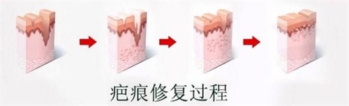 韩国疤痕修复怎么样？看我在韩国做的疤痕修复真的不错！