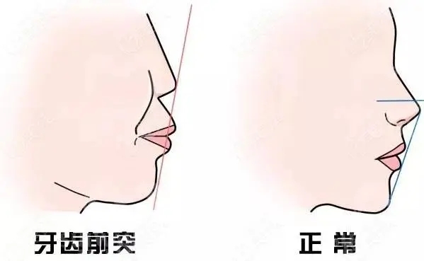 韩国凸嘴矫正怎么样？不光改善嘴突，连下巴线条都出来了，效果太惊艳！