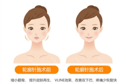 我在韩国做了轮廓提升：怕痛姐妹可试，酸胀感能忍，打完轮廓更紧致
