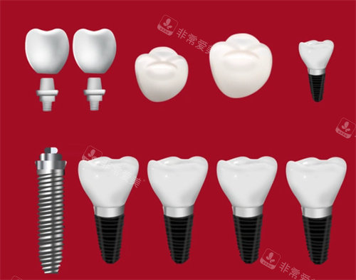 种植牙种植体牙冠