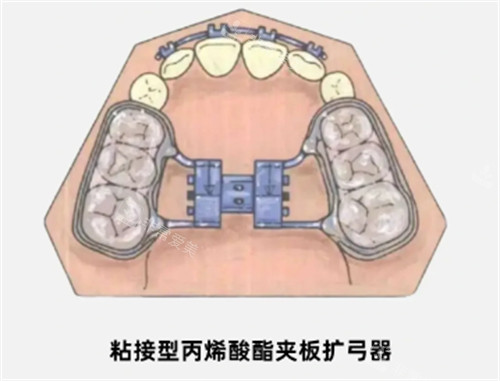基托式螺旋扩弓器多少钱