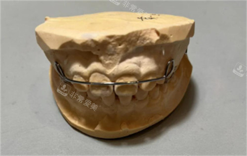 基托式螺旋扩弓器怎么样