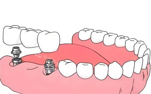 种植牙材料卡通展示图