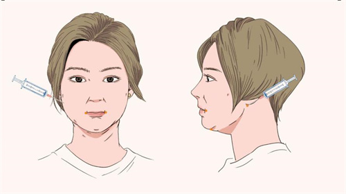 29岁女性适合做的整形项目: 面部吸脂+埋线提升实现从“发腮”到“紧致”的逆袭！