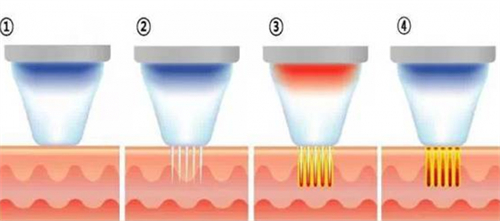 杭州愛琴海5代黃金微針價格多少?5000元起|親歷者說痛感低|比4代出針速度快|修復也快|3天都沒印子了