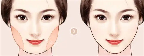 腰腹吸脂对比卡通图