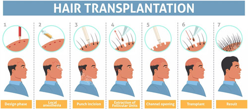 头发种植流程图一览