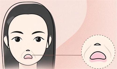 在韩国体验超声炮效果好：淡化法令纹、收紧苹果肌，改善面部下垂问题