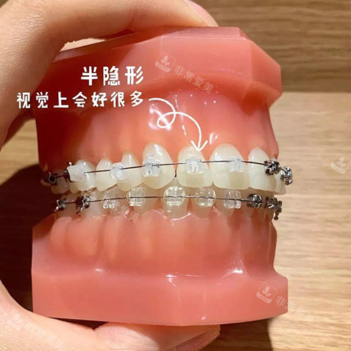 牙齿矫正陶瓷自锁托槽模型