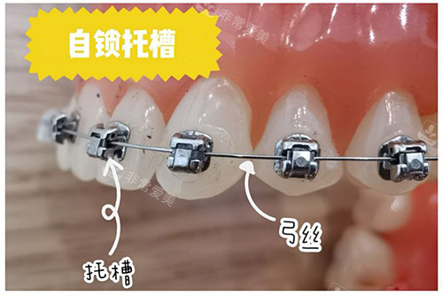 牙齿矫正自锁托槽牙套