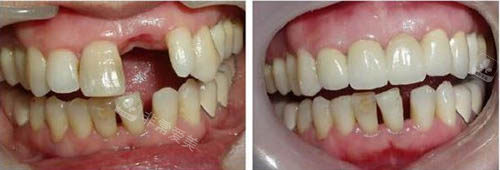 种植牙手术前后图