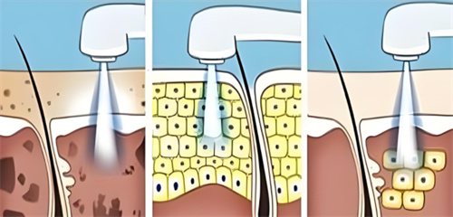 郑州去斑祛痘医院排名:多数人选美丽臻医疗美容,韩系光电去斑祛痘不留印!