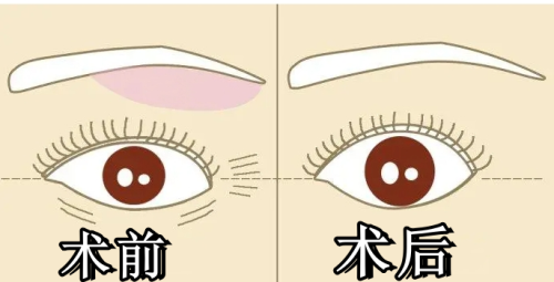 昆明做提眉什么医院比较正规？矫点整形、梦想整形、吴氏嘉美、韩辰都是很正规靠谱的医院！