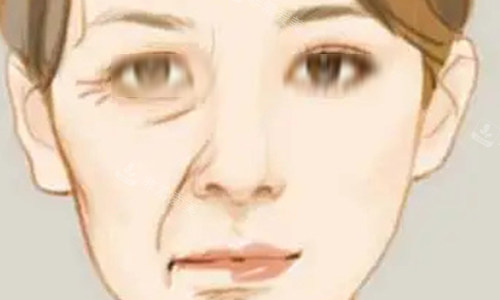 拉皮手术的对比动画图 拉皮手术的对比动画图