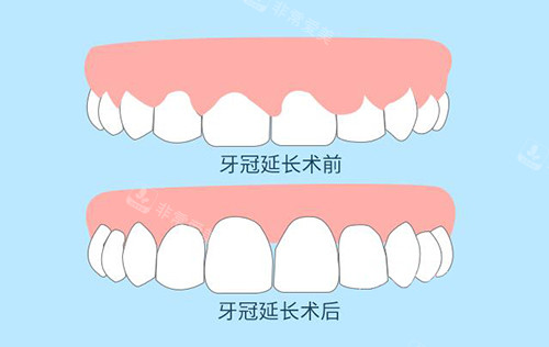 牙冠延长前后对比照片